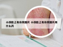 小孩脸上有白斑图片 小孩脸上有白斑图片用什么药