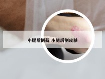 小腿后侧藓 小腿后侧皮肤