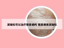 派瑞松可以治疗银屑病吗 银屑病用派瑞松