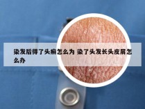 染发后得了头癣怎么为 染了头发长头皮屑怎么办