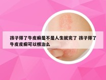 孩子得了牛皮癣是不是人生就完了 孩子得了牛皮皮癣可以根治么