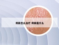 阴藓怎么治疗 阴癣是什么