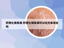 肝硬化银屑病 肝硬化银屑病可以吃热毒清锭吗