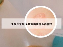 头皮长了癣 头皮长癣用什么药膏好