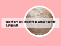 银屑病关节炎可以吃药吗 银屑病关节炎吃什么药有效果