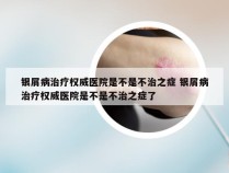 银屑病治疗权威医院是不是不治之症 银屑病治疗权威医院是不是不治之症了