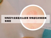 特殊型牛皮癣是怎么回事 特殊部位的银屑病有哪些