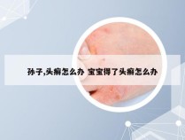 孙子,头癣怎么办 宝宝得了头癣怎么办