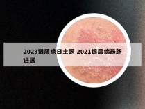 2023银屑病日主题 2021银屑病最新进展