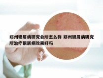 郑州银屑病研究会所怎么样 郑州银屑病研究所治疗银屑病效果好吗