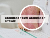 酒石酸美托洛尔片银屑病 酒石酸美托洛尔片治疗什么病?