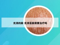 光滑的藓 光滑苔藓需要治疗吗