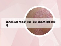 白点癫风图片早初位置 白点癫风早期能治愈吗