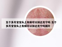 五个多月宝宝头上有癣可以抹达克宁吗 五个多月宝宝头上有癣可以抹达克宁吗图片