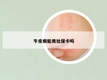 牛皮癣能用社保卡吗