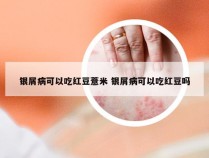 银屑病可以吃红豆薏米 银屑病可以吃红豆吗