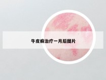 牛皮癣治疗一月后图片