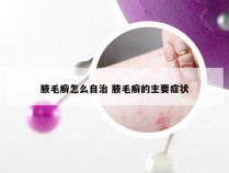 腋毛癣怎么自治 腋毛癣的主要症状