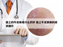 腿上的牛皮癣用什么药好 腿上牛皮肤癣的症状图片