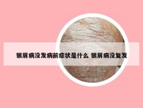 银屑病没发病前症状是什么 银屑病没复发