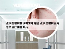 点滴型银屑有没有生命危险 点滴型银屑图片怎么治疗用什么药