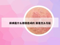 藓病是什么原因造成的 藓是怎么引起