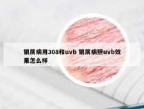 银屑病用308和uvb 银屑病照uvb效果怎么样