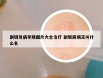 副银屑病早期图片大全治疗 副银屑病又叫什么名