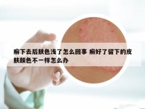 癣下去后肤色浅了怎么回事 癣好了留下的皮肤颜色不一样怎么办