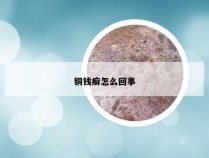 铜钱癣怎么回事