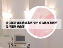 哈尔滨治银屑病哪家医院好 哈尔滨哪家医院治疗银屑病最好