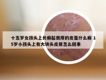 十五岁女孩头上长癣起很厚的皮是什么癣 15岁小孩头上有大块头皮屑怎么回事