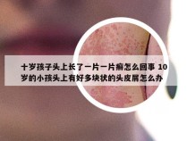 十岁孩子头上长了一片一片癣怎么回事 10岁的小孩头上有好多块状的头皮屑怎么办