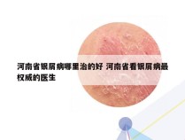 河南省银屑病哪里治的好 河南省看银屑病最权威的医生