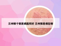 兰州哪个银屑病医院好 兰州银屑病在哪