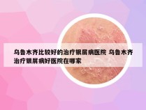 乌鲁木齐比较好的治疗银屑病医院 乌鲁木齐治疗银屑病好医院在哪家