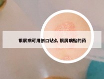 银屑病可用创口贴么 银屑病贴的药