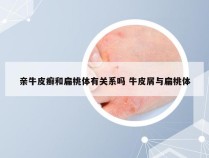 亲牛皮癣和扁桃体有关系吗 牛皮屑与扁桃体