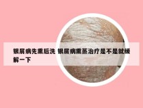 银屑病先熏后洗 银屑病熏蒸治疗是不是就缓解一下