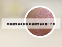 银屑病关节炎验血 银屑病关节炎查什么血