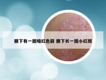 腋下有一圈暗红色藓 腋下长一圈小红斑