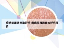 癣病能用激光治好吗 癣病能用激光治好吗图片