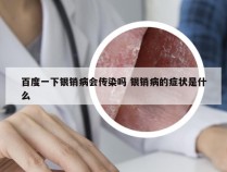 百度一下银销病会传染吗 银销病的症状是什么