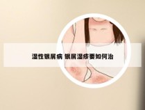 湿性银屑病 银屑湿疹要如何治