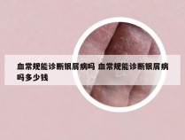 血常规能诊断银屑病吗 血常规能诊断银屑病吗多少钱