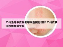 广州治疗牛皮癣去哪家医院比较好 广州皮肤医院银屑病专科