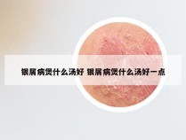 银屑病煲什么汤好 银屑病煲什么汤好一点