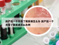 刮产后一个月得了银屑病怎么办 刮产后一个月得了银屑病怎么办啊