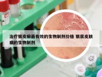 治疗银皮癣最有效的生物制剂价格 银屑皮肤病的生物制剂