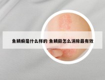 鱼鳞癣是什么样的 鱼鳞藓怎么消除最有效